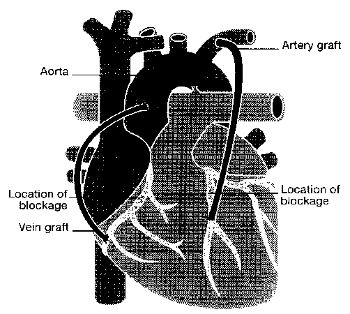 Outer view of heart showing how grafts are used to "bypass" blocked arteries.