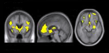 MRI images 