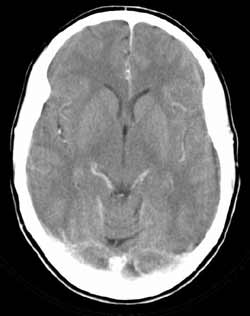 image of CT scan of brain