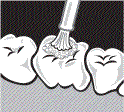Illustration: The tooth is cleaned.