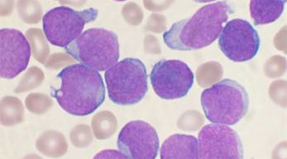 Microscopic image of acute lymphoblastic leukemia, with cancer cells appearing as larger, irregular purple circles against a background of smaller, regular-shaped beige-colored cells.
