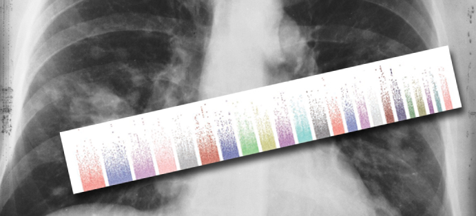 This is an image of a genetic plot showing results from a GWAS study of never-smoking Asian women; the image is overlaid on a lung X-ray.