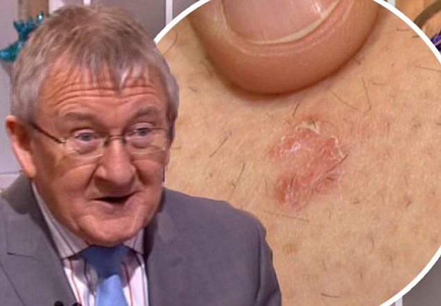 This Morning doctor Chris Steele reveals he has been diagnosed with skin cancer for the second time