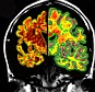 A diseased brain- showing the effects of dementia. The new device appears to keep brain neurons active and help prevent cognitive decline