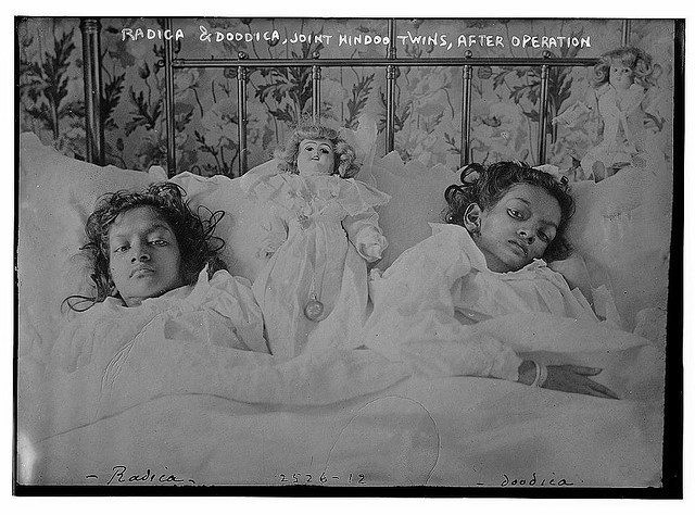 Radica & Doodica, Joint Hindoo twins after operation (LOC)
