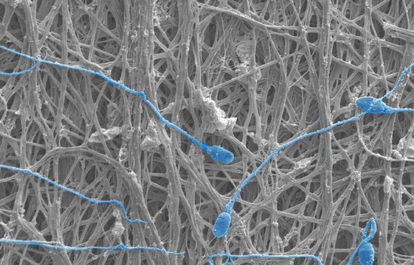 Sperm, shown in blue, collect against an electrospun mesh of nanofibers that can release spermicides and form a physical barrier to protect against unplanned pregnancy.