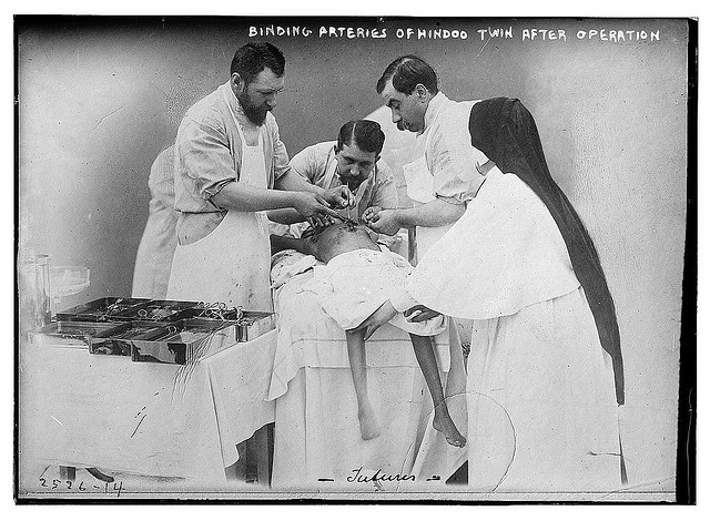 Binding arteries of Hindoo twins after operation (LOC)