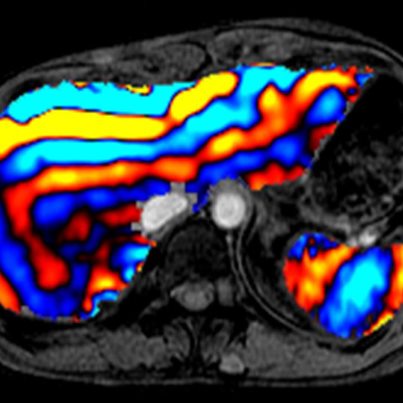 Photo: Researchers at Duke University have developed a new ultrasound imaging technique that non-invasively detects tumors and fibrosis in the liver, thus avoiding the pain and complications associated with biopsy. These researchers are also extending the technique to aid in diagnosing other diseases, as well. 

Learn More: http://www.nibib.nih.gov/NewsEvents/ResearchHighlights/HighlightOnHealth/Nightingale
