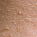 Image of close-up of papules on the patient’s upper back