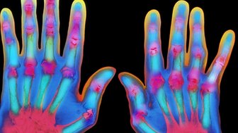 Coloured X-ray of hands suffering from severe rheumatoid arthritis
