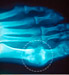 Xray of foot highlighting gout