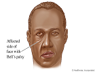 Bell Palsy Treatment Guidelines Are Updated