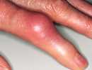 New Guidelines Issued for Gout Management
