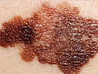 Cutaneous Clues to Diagnosing Metastatic Cancer