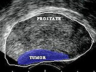 Prostate Cancer: Definitive Diagnosis and Staging