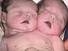 Rare and Unusual Complications of Twin Pregnancies