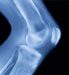 Osteoarthritis Overview Slideshow