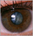 cataracts on eye