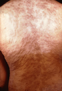 secondary rash from syphilis on torso