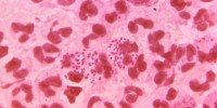Almost-Untreatable Gonorrhea: Proof That It’s Here