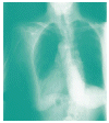 Does TB affect only the lungs?