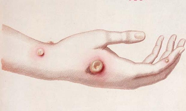 Hand showing small pox pustules