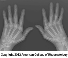 X ray of hands showing damage to joints from rheumatoid arthritis.