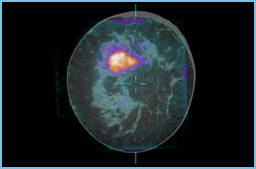 Novel Breast CT Scanner Enhances Ability to Discern Tumors