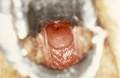 Diethylstilbestrol (DES) Cervix