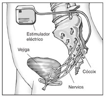 Diagrama de un dispositivo de estimulación eléctrica implantado en el abdómen de una mujer. Se etiqueta al estimulador eléctrico, la vejiga, el cóccix y los nervios.