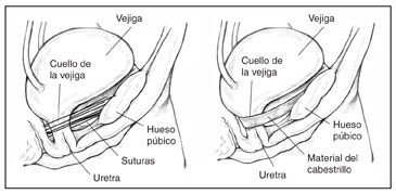 Dos diagramas de la vejiga sostenida en su lugar luego de una cirugía. En la izquierda, la vejiga se mantiene en el puesto con suturas. Se etiqueta la vejiga, el cuello de la vejiga, el hueso púbico, las suturas y la uretra. En la derecha, la vejiga se mantiene en su lugar con un cabestrillo. Se etiqueta la vejiga, el cuello de la vejiga, el hueso púbico, el material del cabestrillo y la uretra.