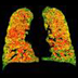 Images of lungs with green, yellow and red areas.