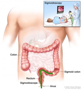 Image shows sigmoidoscope inserted through the anus and rectum and into the sigmoid colon. Inset shows patient on table having a sigmoidoscopy