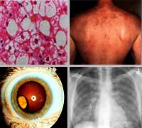 A montage of 4 images for HIV clinical manifestations