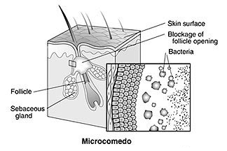 Illustration of lesion, Microcomedo