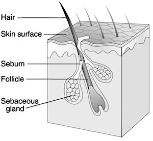 Diagram of a narmal pilosebaceous unit, showing location of: Hair, Skin surface, sebum, follicle, and sebaceous gland.