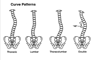 Illustration showing curvature in the thoracic, lumbar, thoracolumbar, regions, and double curvature of the spine