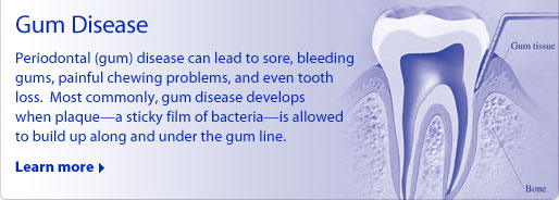 Gum Disease: Periodontal (gum) disease can lead to sore, bleeding gums, painful chewing problems, and even tooth loss.  Most commonly, gum disease develops when plaque--a sticky film of bacteria--is allowed to build up along and under the gum line.
