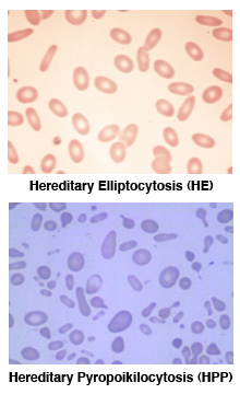 Hereditary Elliptocytosis