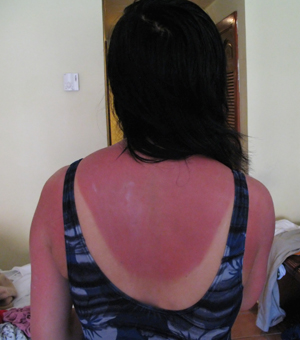 Example of a woman with severe sunburn on her back and arms