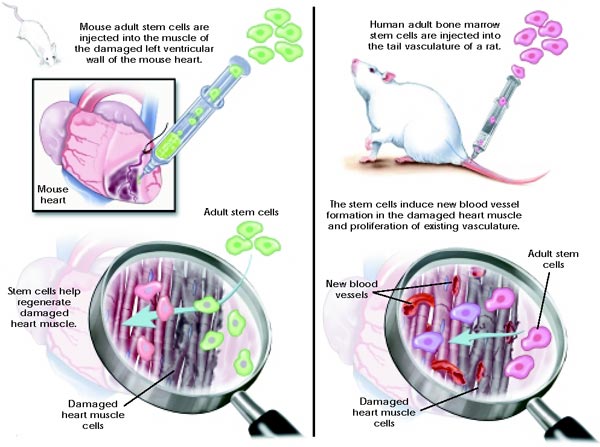 Heart muscle repair with adult stem cells. This figure is divided into two panels, with each illustrating a possible means by which adult stem cells could help regenerate damaged heart muscle. On the left, a mouse heart is being injected with a syringe of green-labeled adult stem cells. Next, a magnifying glass shows a close-up of the damaged heart muscle cells (greyish-black) next to an area of healthy heart muscle (pink). Arrows indicate that the adult stem cells are intermingling with the heart muscle fibers.  On the right, a mouse is shown being injected in the tail blood vessels with a syringe of pink human bone marrow stem cells. The magnifying glass in this panel again shows a close-up of the damaged heart muscle cells (greyish-black) next to an area of healthy heart muscle (pink). The pink human bone marrow stem cells intermingle with the heart muscle fibers and the text indicates that they induce new blood vessel formation  in the damaged heart muscle and also cause proliferation of existing heart blood vessels.