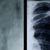 X-ray image of two lungs, one with ARDS and the other normal. Courtesy:  Trauma.org Image Database