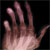 X-ray of an arthritic hand