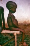 Photo of an African girl with thin limbs and a distended abdomen.