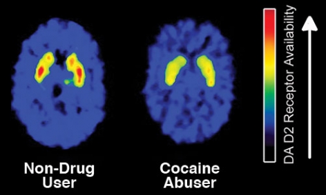An image of a non-drug user brain beside a drug-user brain.
