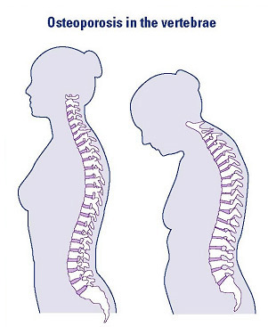 Diagram of osteoporosis in the vertebrae
