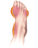 Parts of the foot affected by gout. - Click to enlarge in new window.