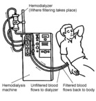 Drawing of a person getting a dialysis treatment - Click to enlarge in new window.