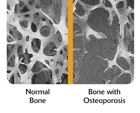 Normal vs. osteoporotic bone. - Click to enlarge in new window.