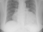 chest X-ray shows enlarged heart due to pulmonary hypertension